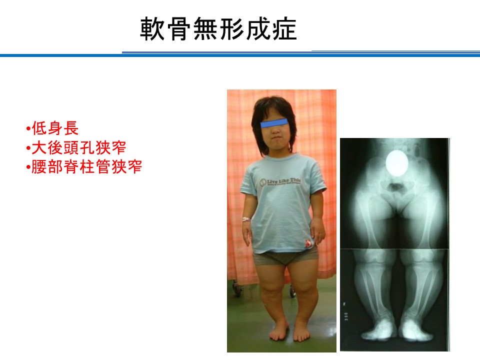 骨軟骨症の診断と治療